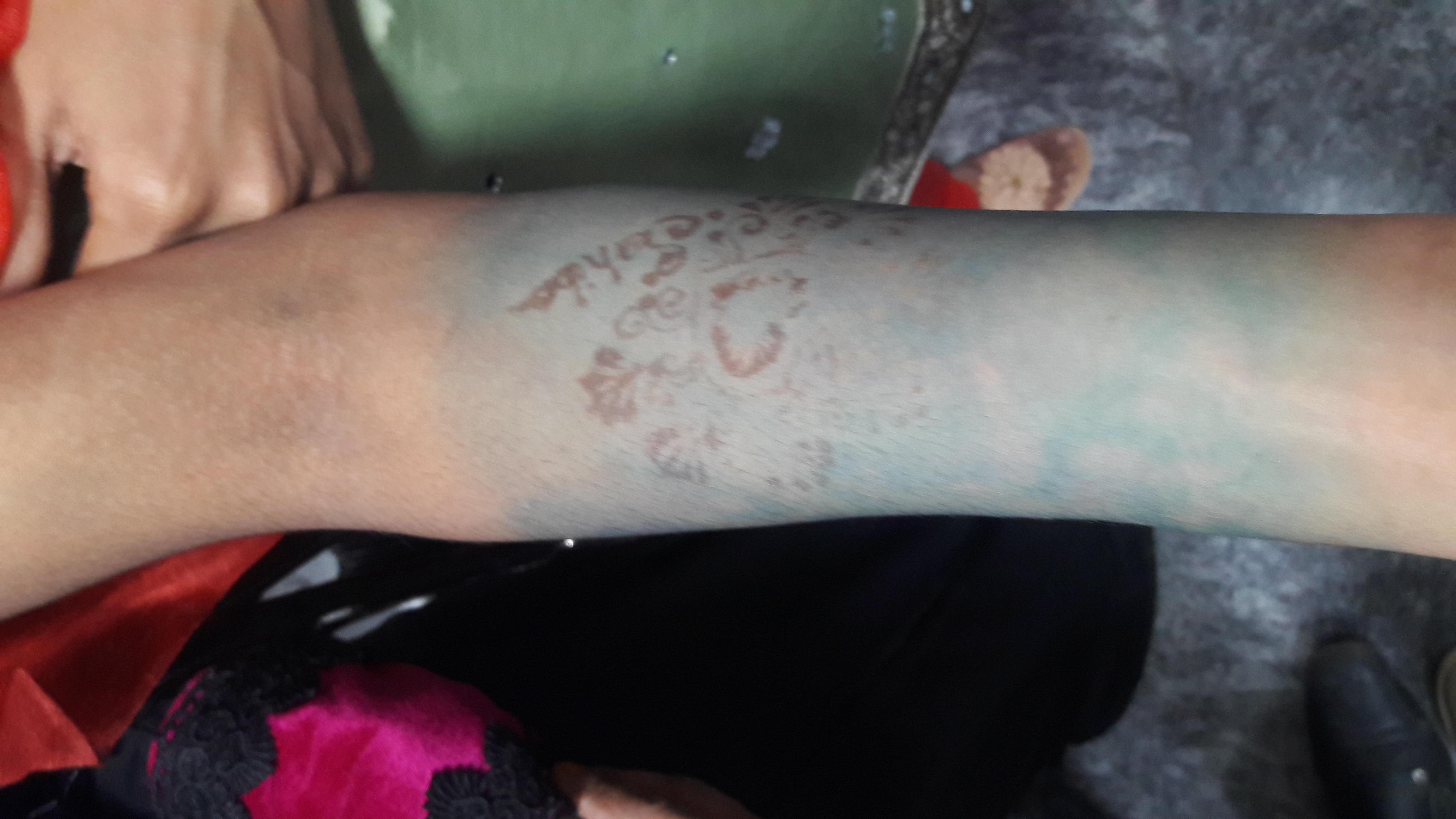 Colour Of Skin, Is It Eosinophilic Cellulitis?